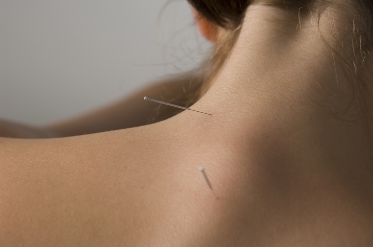 espalda tratamiento acupuntura regular
