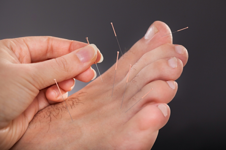 pies detalles acupuntura estimulante