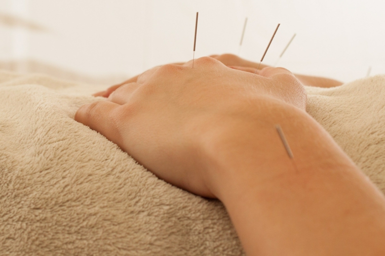 puntos manos tratamiento acupuntura