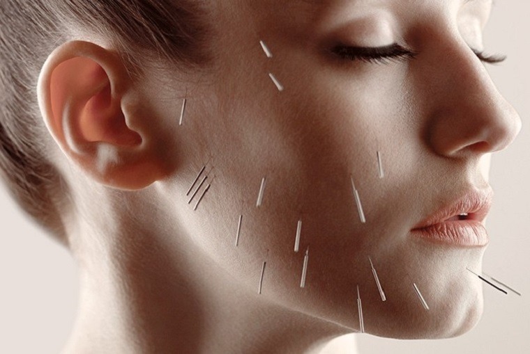 acupuntura facial-ideas-consejos