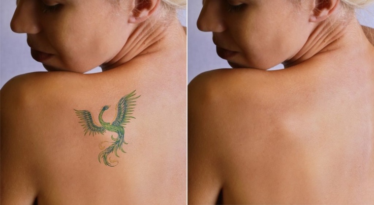 eliminación de tatuajes antes y después