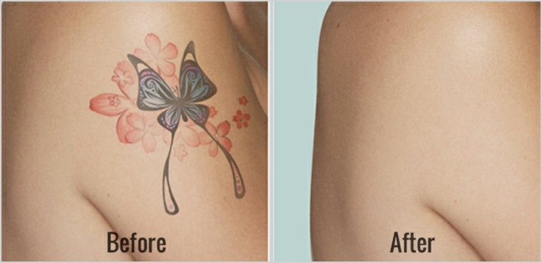 eliminación de tatuajes con láser
