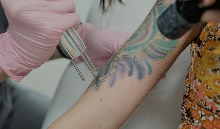 eliminación de tatuajes láser