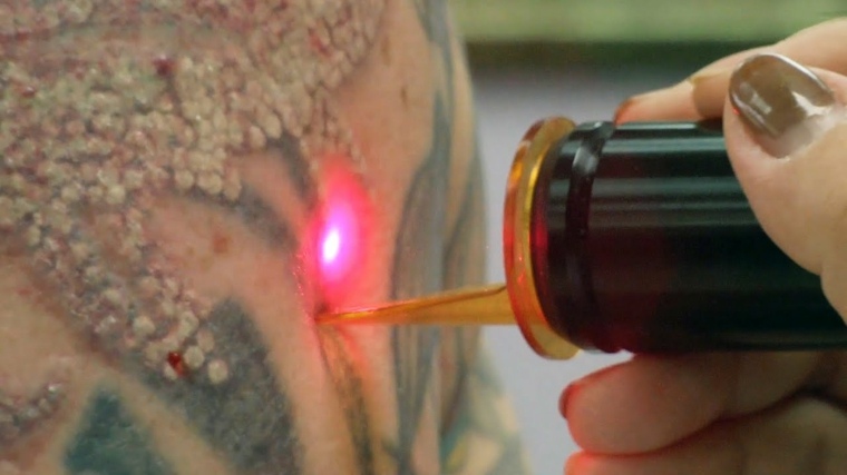 eliminación de tatuajes proceso