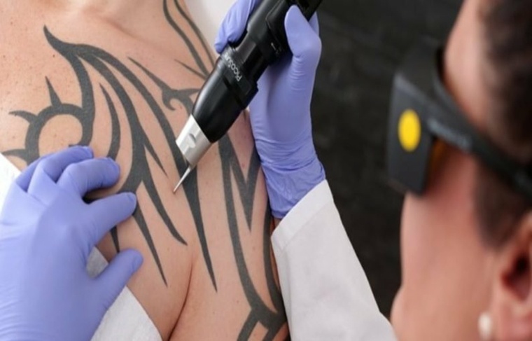 eliminación de tatuajes tratamiento