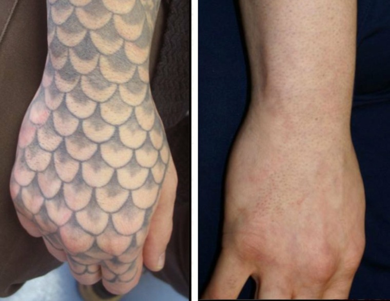 quitar tatuajes antes y después