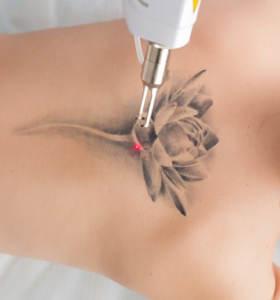 Quitar tatuajes con láser ¿Qué debes seber antes de someterte a este tratamiento?