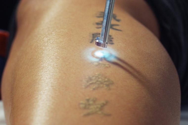 tatuajes tratamiento con láser