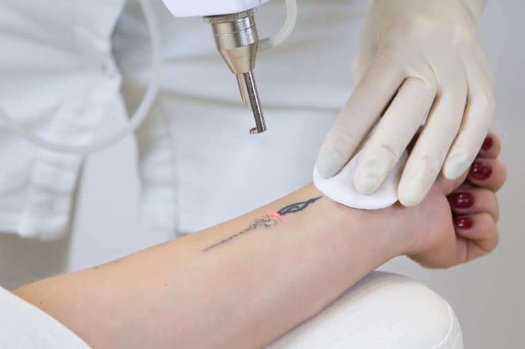 tratamiento láser para quitar tatuajes