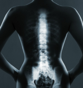 Ejercicios lumbares para la escoliosis y fortalecer la espalda