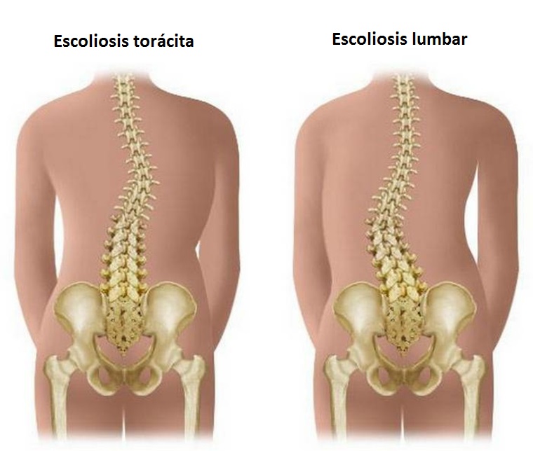 Tipos de escoliosis