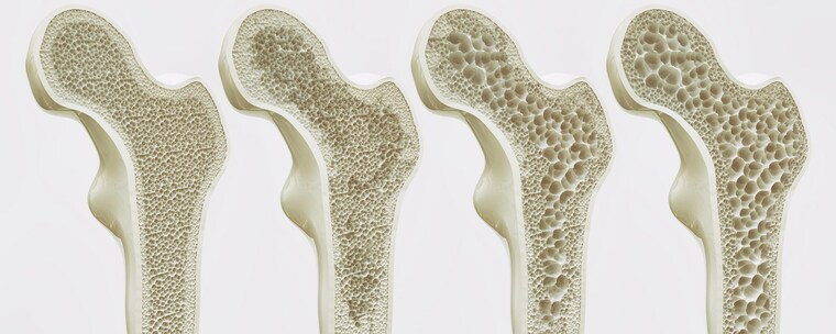 los refrescos ⁣osteoporosis