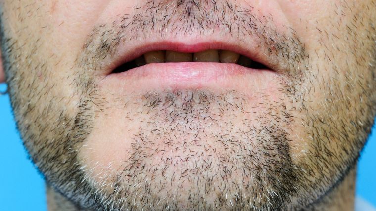 alopecia areata barba