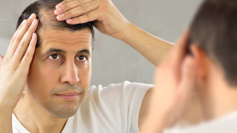 alopecia calvicie