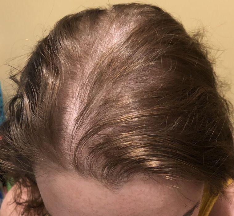 alopecia desarrollo