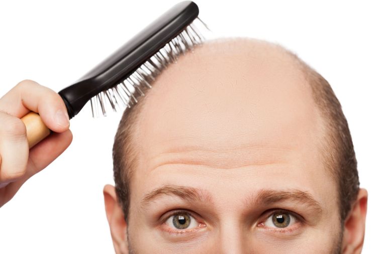 alopecia genetico