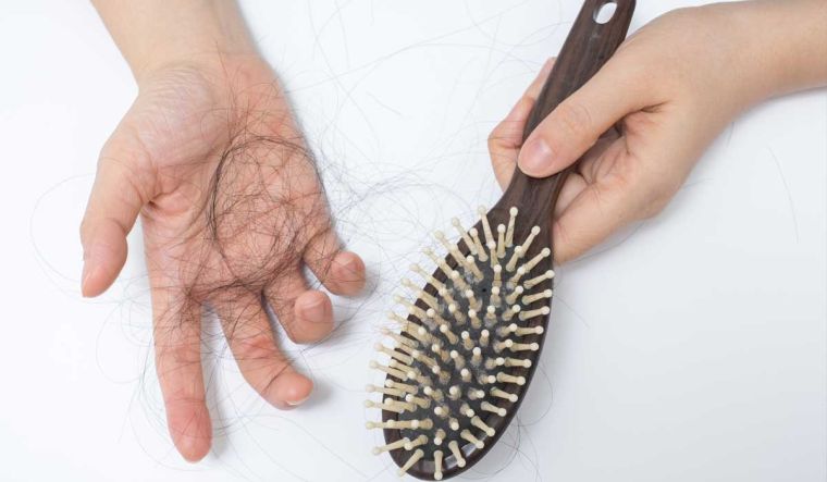 alopecia hormonas