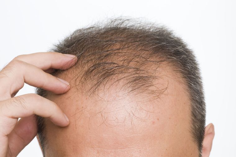alopecia mala nutricion