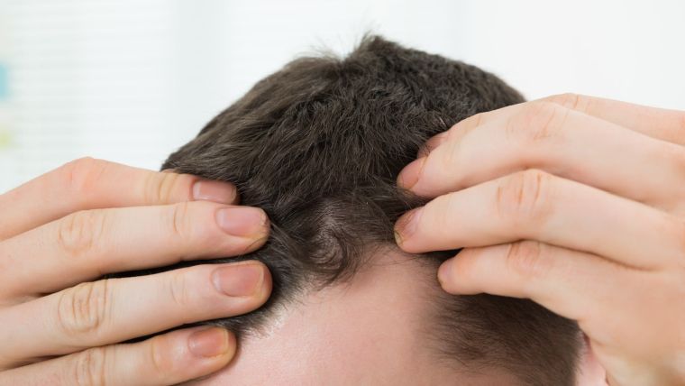 alopecia perdida