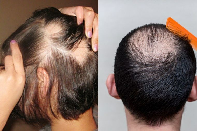 alopecia tipos