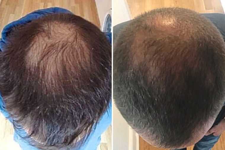 alopecia tratamiento
