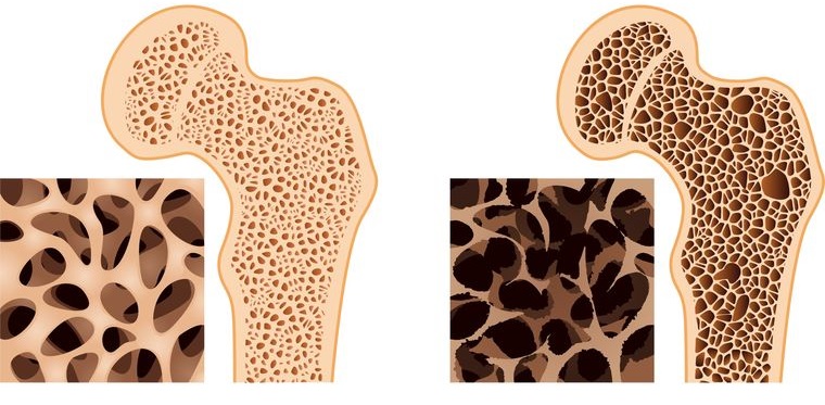el azúcar ocasiona osteoporosis
