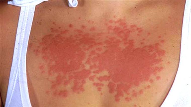 alergia al sol prurigo actínico
