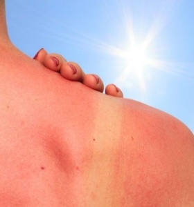 Quemaduras por el sol – Cómo lidiar con ellas y minimizar los síntomas