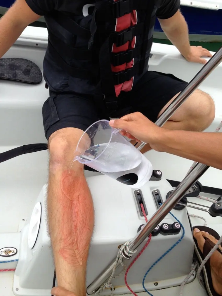 como tratar una picadura de medusa