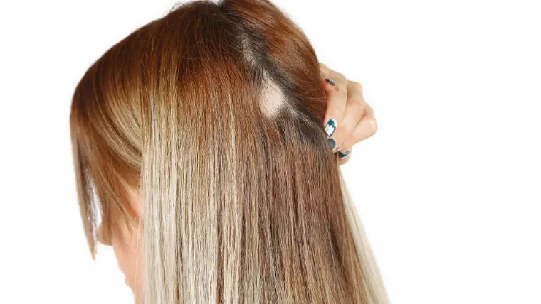 doença do cabelo alopecia areata