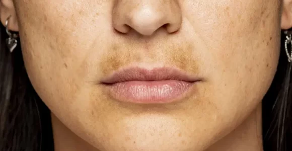 bigote pigmentación ideas